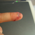 My finger the day after getting whacked.