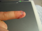 My finger the day after getting whacked.